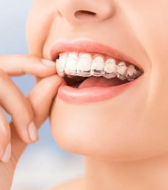 Orthodontics Oakville - Invisalign Oakville