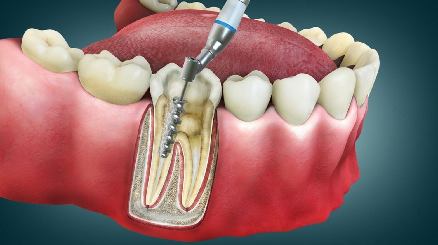 root canal north oakville