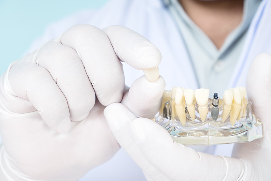 oaville implants GTA dental implants