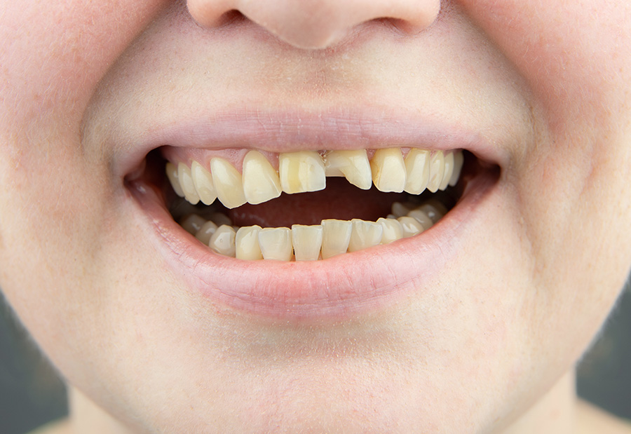 chipped tooth oakville